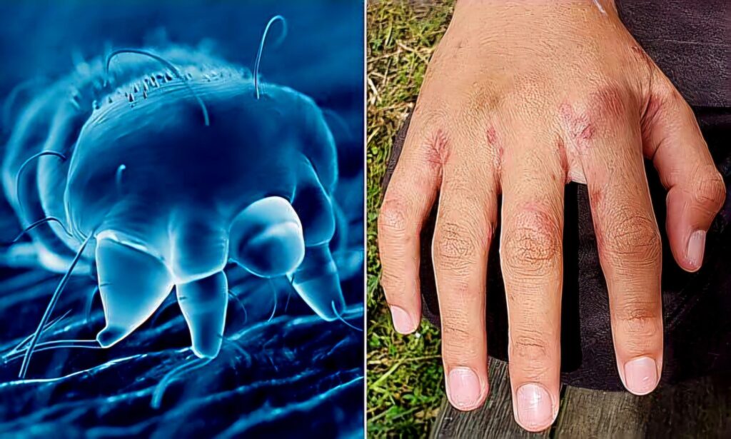 scabies স্ক্যাবিস